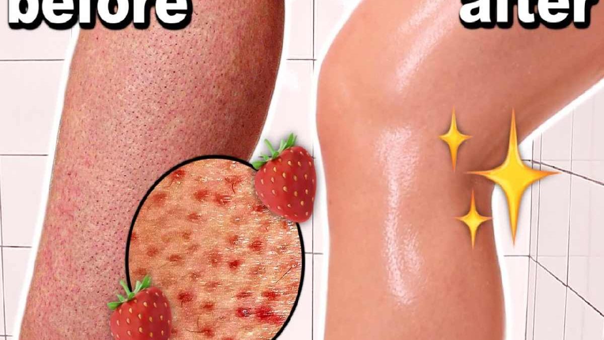 How to Get Rid of Strawberry Legs