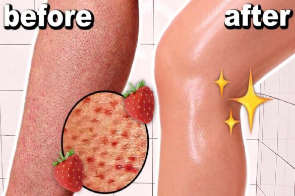 How to Get Rid of Strawberry Legs